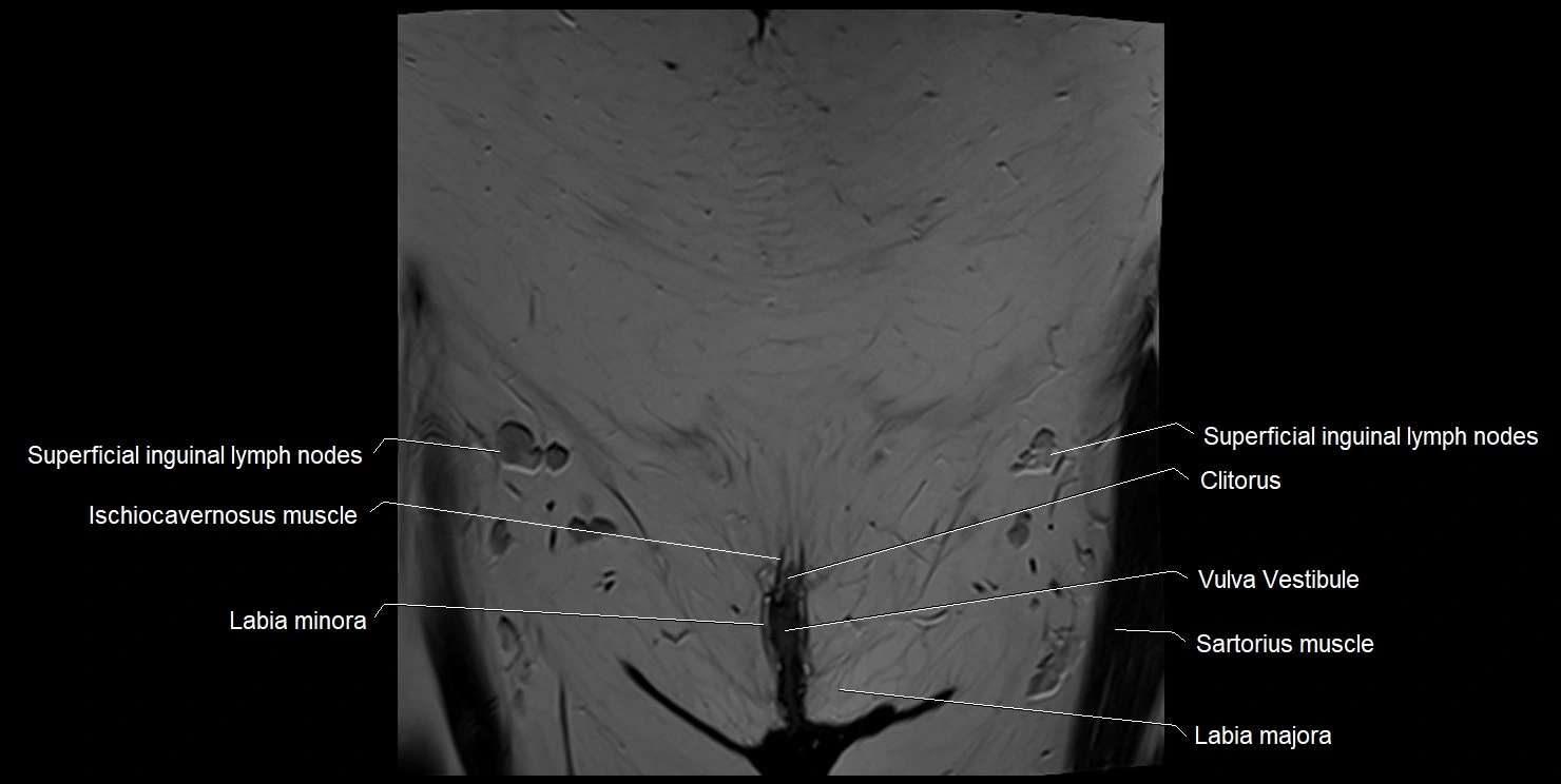 female pelvis coronal cross sectional anatomy image 2.webp